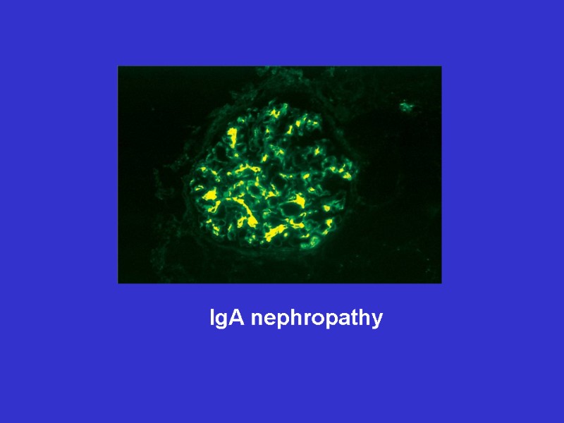 IgA nephropathy